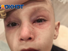 Семилетний мальчик травмировал глаз на детской площадке Ростова из-за неотремонтированного ограждения 
