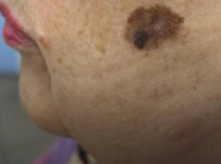 Давнее пятно на щеке ростовчанки оказалось проявлением опасного заболевания