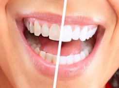 Белоснежную улыбку подарят ростовские стоматологи своим пациентам