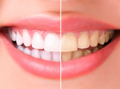 Ростовская стоматология дарит летние скидки для красивой улыбки на долгие годы