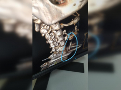 В Ростове врачи спасли женщине жизнь, достав из ее пищевода кость от шашлыка