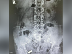 В Ростовской области из женщины извлекли проглоченный зубной протез
