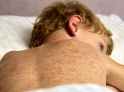 В 17 детских садах и школах Ростовской области выявили корь и ввели ограничения