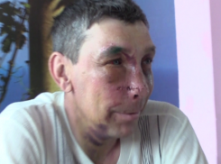 Ростовские врачи сняли мужчине кожу с лица, чтобы восстановить внешность