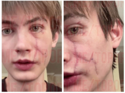 В Ростове парень на электросамокате врезался в отбойник и получил шрамы на лице