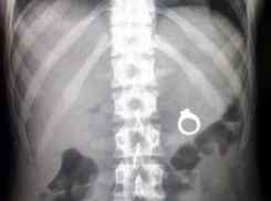 Четырехлетний мальчик случайно проглотил кольцо в Ростове