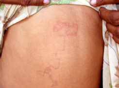 Опасными «шевелящимися под кожей» паразитами заразили комары жителей Ростовской области