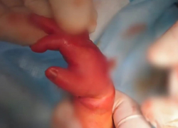 В Ростове младенец чуть не лишился рук из-за антицарапок 