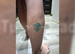 На школьницу напали бездомные собаки и прокусили ногу в Новочеркасске