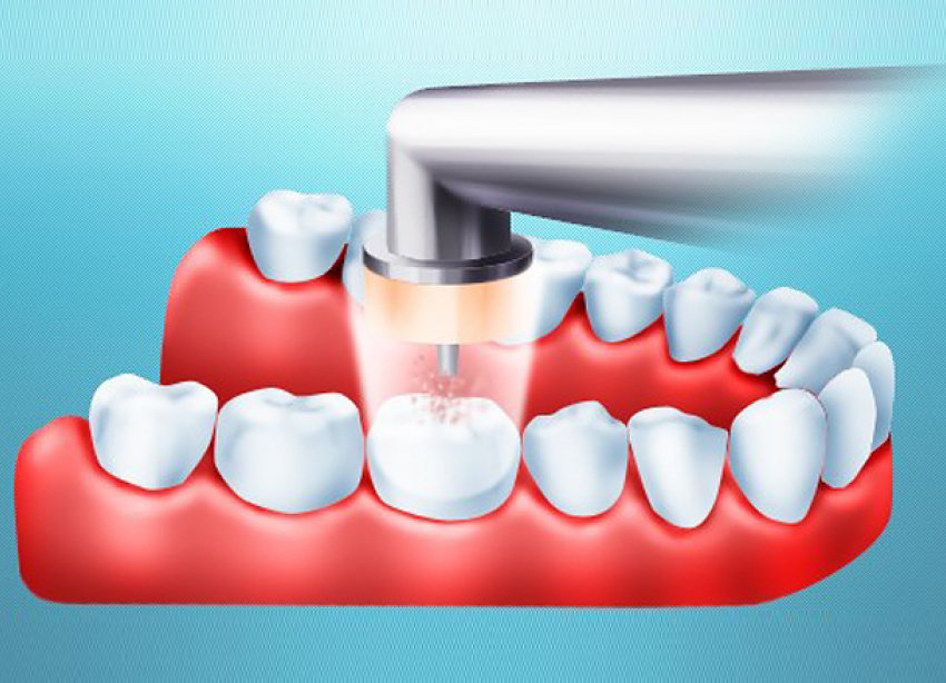 Воздушно-кинетический метод лечения зубов