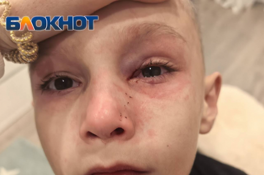 Семилетний мальчик травмировал глаз на детской площадке Ростова из-за неотремонтированного ограждения 