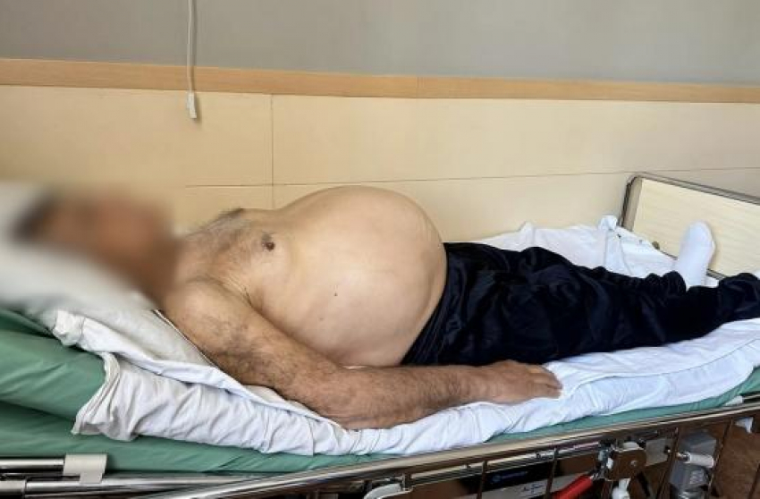 Врачи удалили опухоль весом 15 кг у пациента из Ростовской области