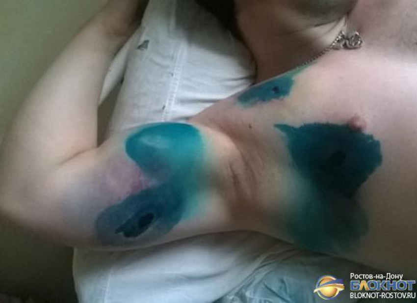 Ростовчанин, подвергшийся нападению толпы, показал синяки и ранения от пуль