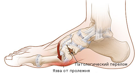 Диабетическая стопа